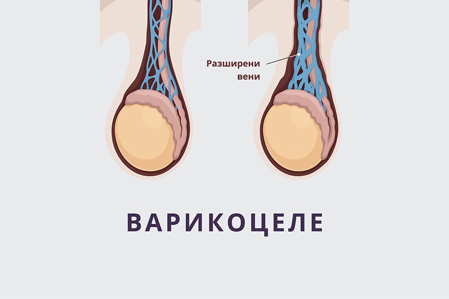Варикоцеле.