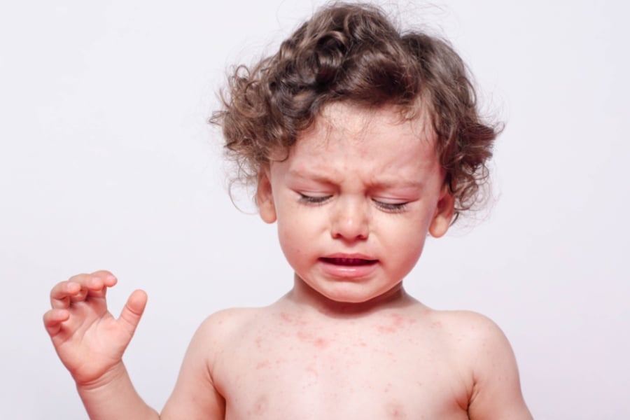 Дете с рубеола