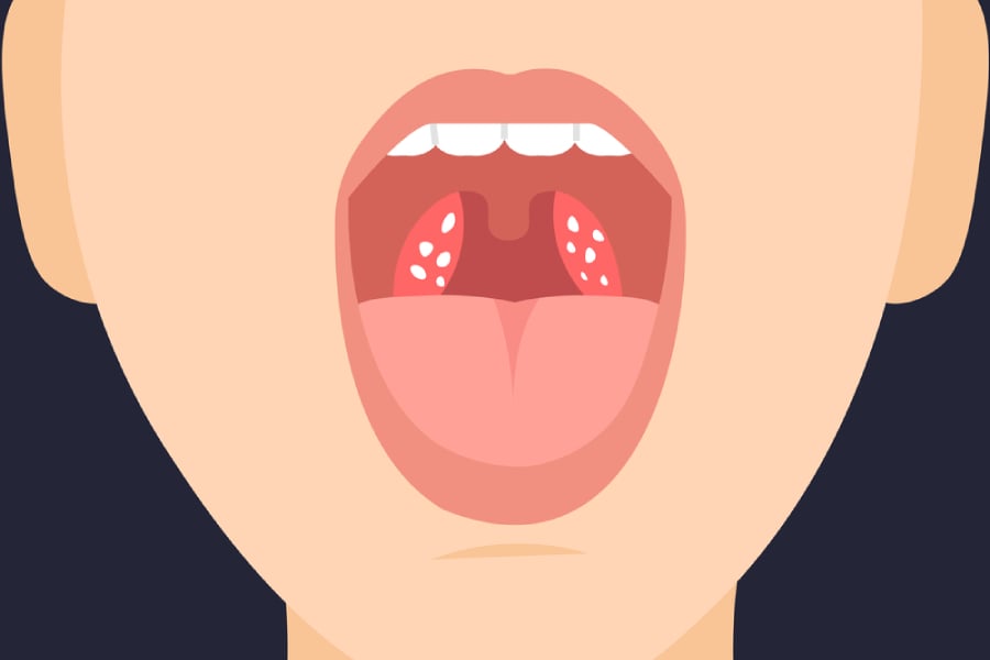 Гнойна ангина - налепи.