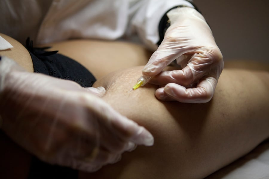 Карбокситерапия при стрии