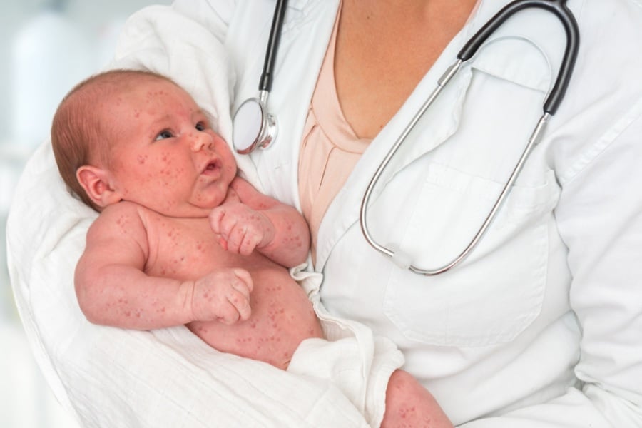 Бебе с рубеола