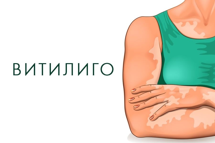 Витилиго, диагноза