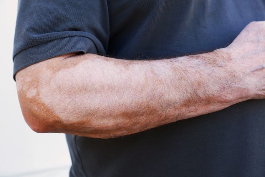 Витилиго по ръцете