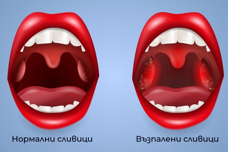 Гнойна ангина: Симптоми, лечение и усложнения 8 Нормално и болно гърло