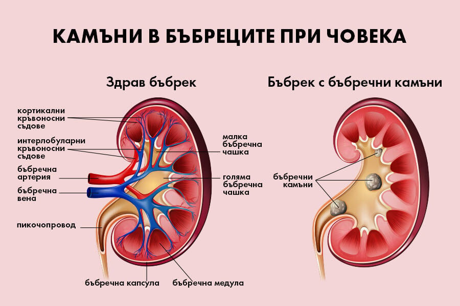 Бъбречна криза: симптоми, причини и лечение 5 Здрав и болен бъбрек