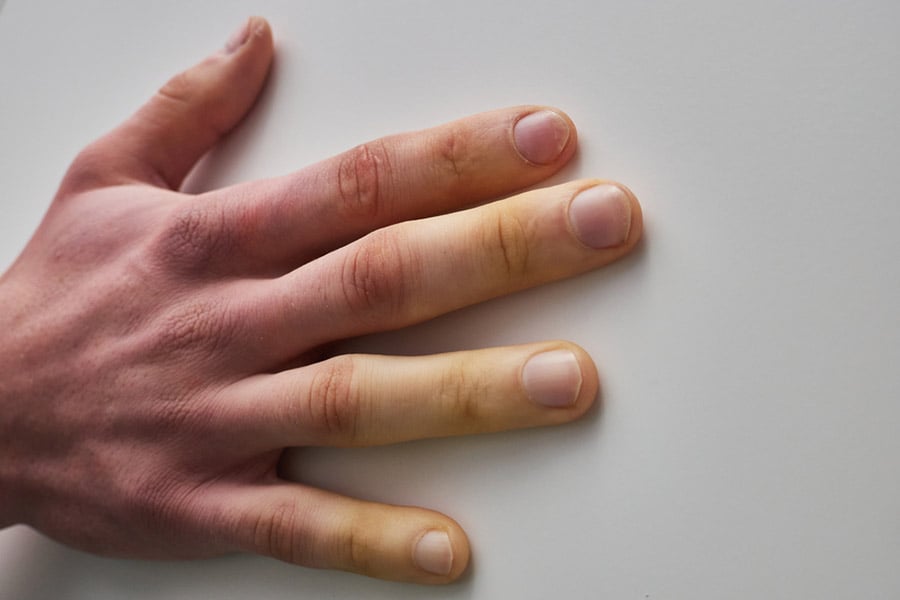 Проф. д-р Златимир Коларов, склеродермия.