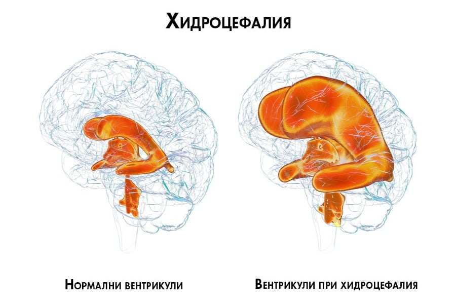 Хидроцефалия, вентрикули