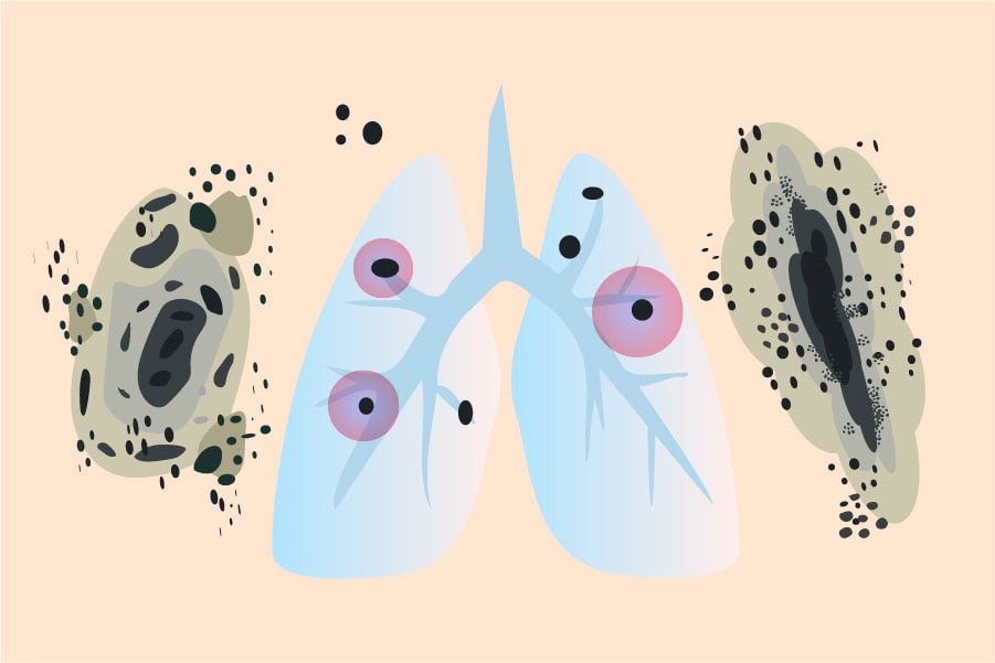 мукормикоза