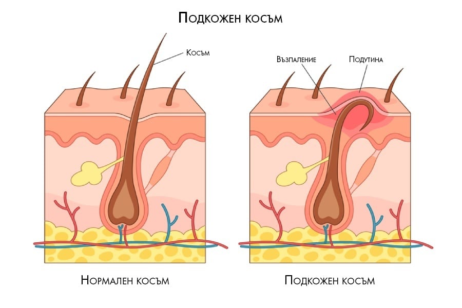 Подкожен косъм