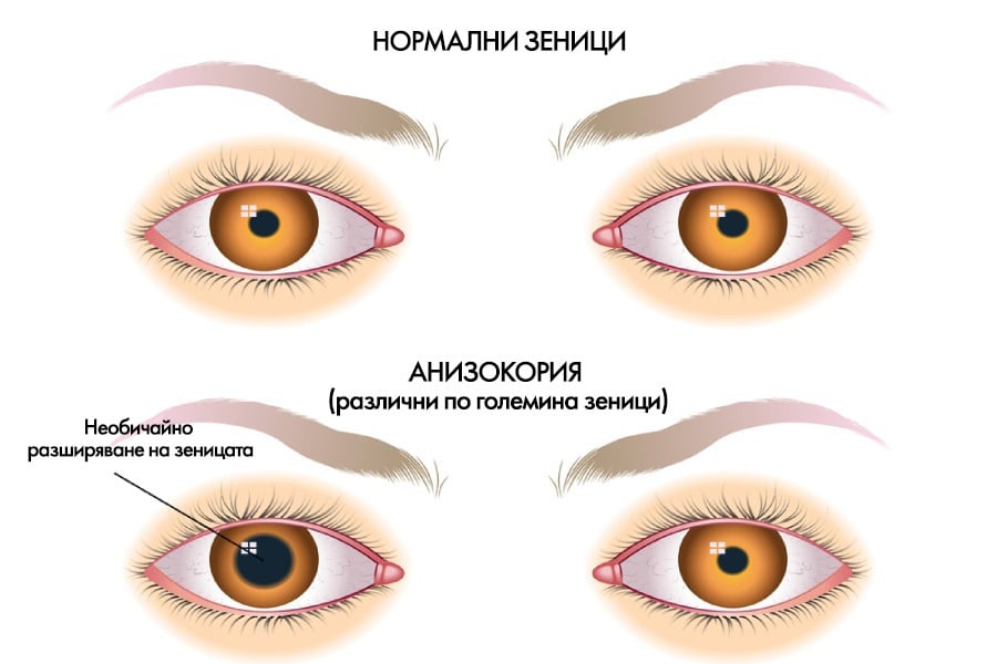 Симптоми на анизокория