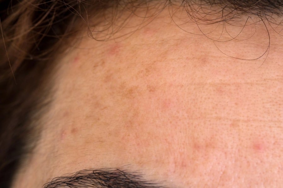 мечо грозде, пигменти петна