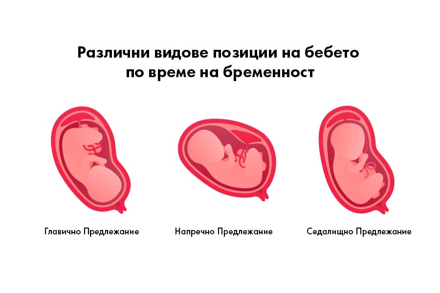 Предлежание на плода, видове