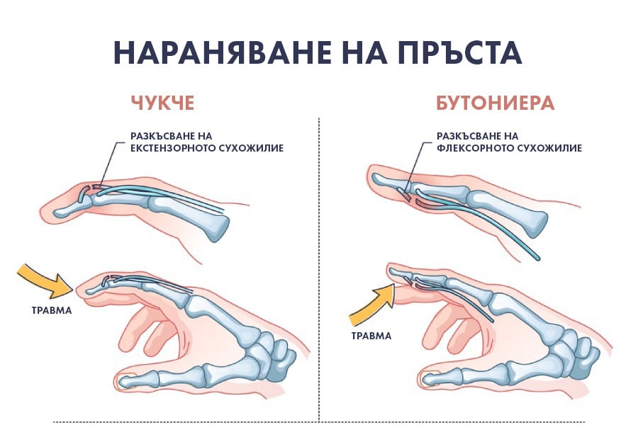 Пръст чукче и бутониера, разлики