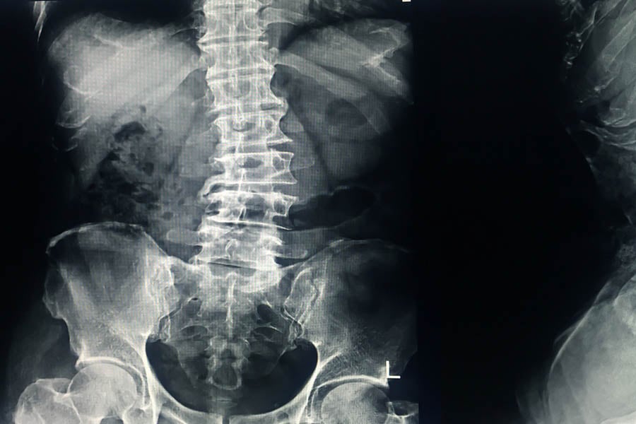 Спина бифида, сколиоза.