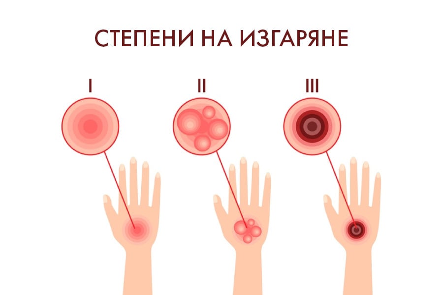 Степени на изгаряне, първа помощ при изгаряне