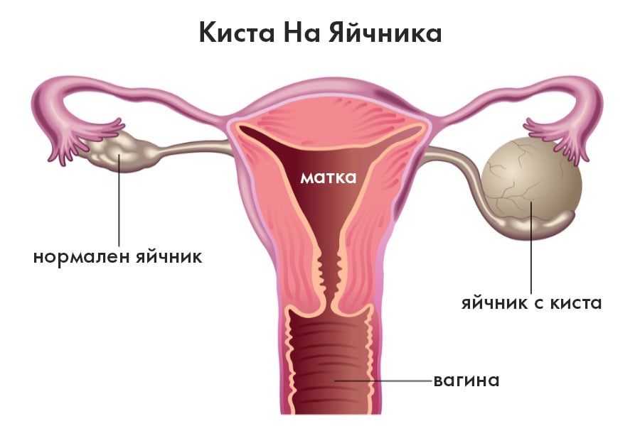 Киста на яйчник, киста на жълтото тяло