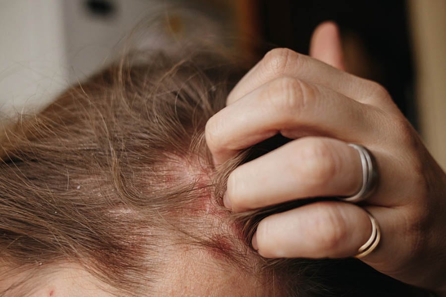 пърхот при дете, псориазис