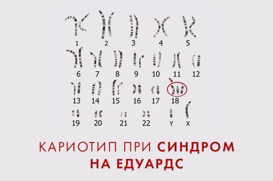 синдром на едуардс