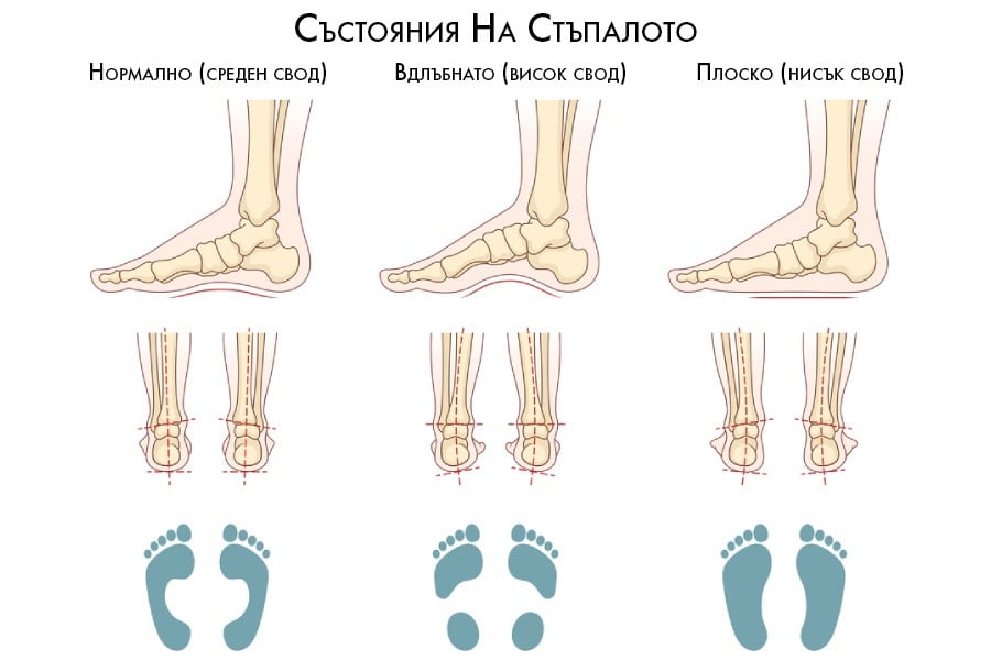Вродени деформации на стъпалото