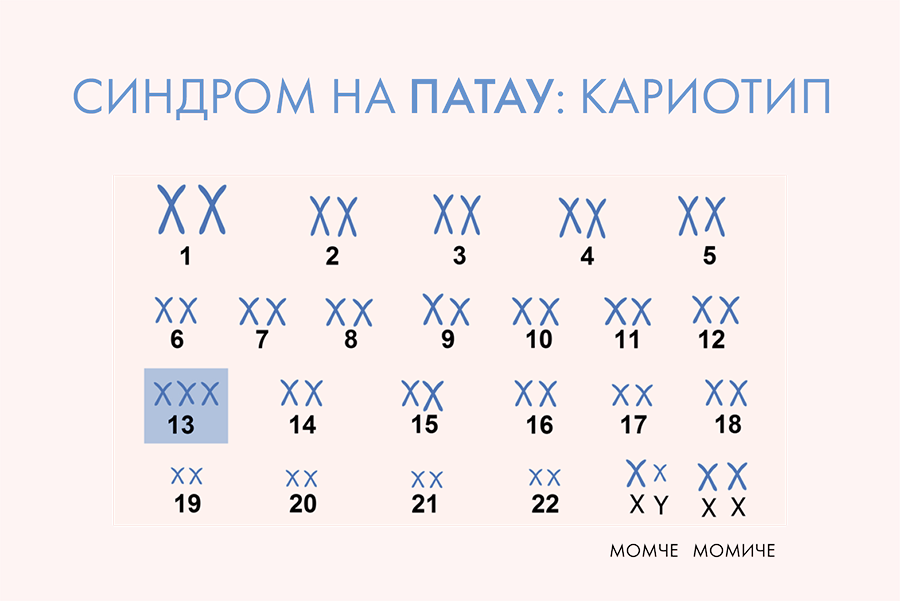 Синдром на Патау.