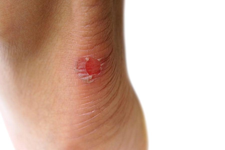 видове пришки