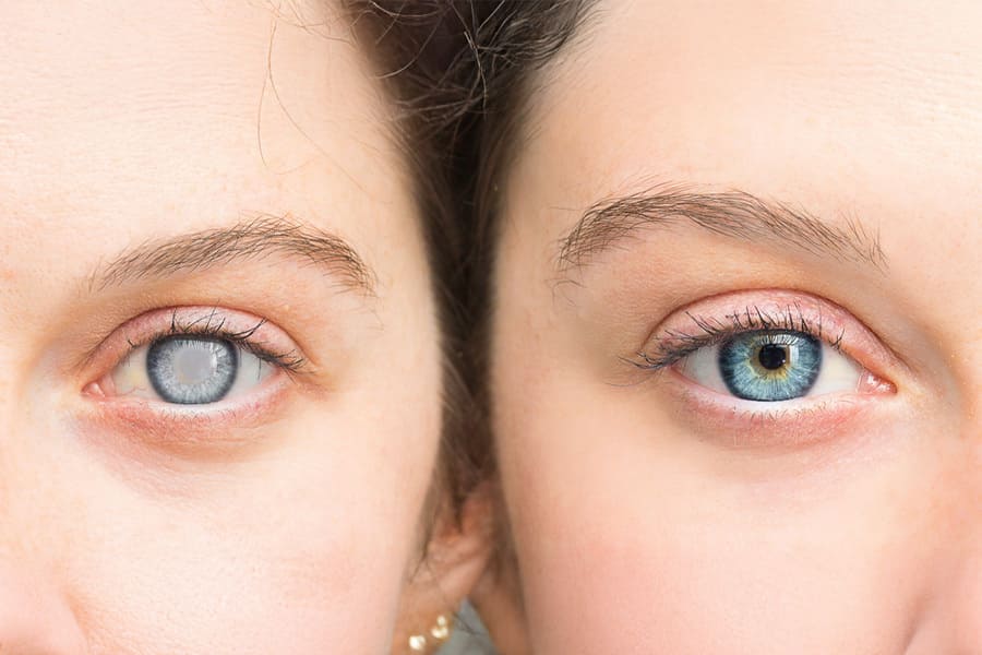 левкокория