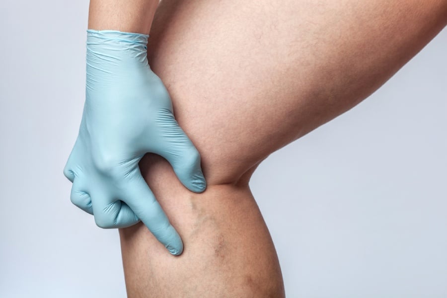 Преглед при склеротерапия.