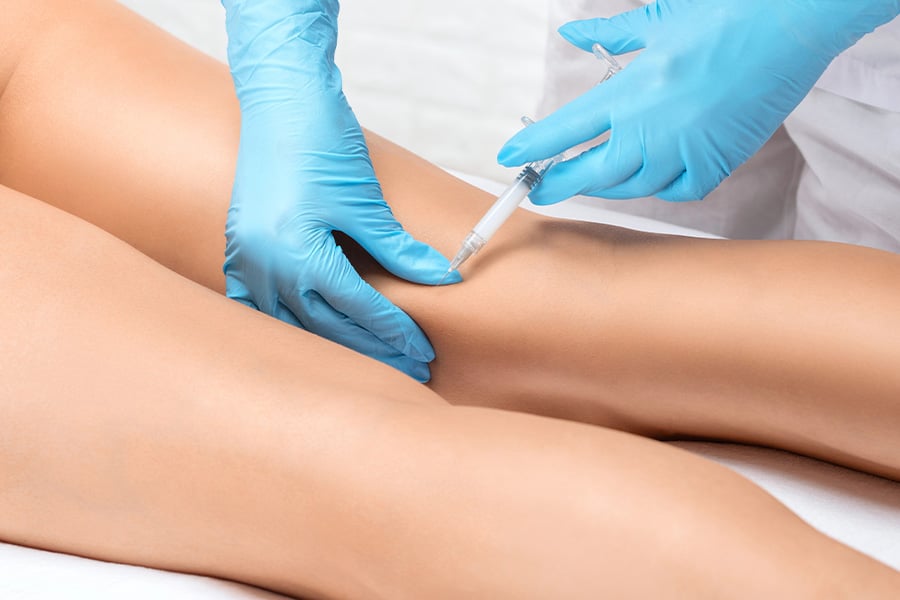 Склеротерапия.