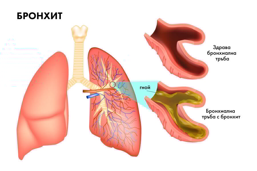 Haemophilus influenzae причинява бронхит