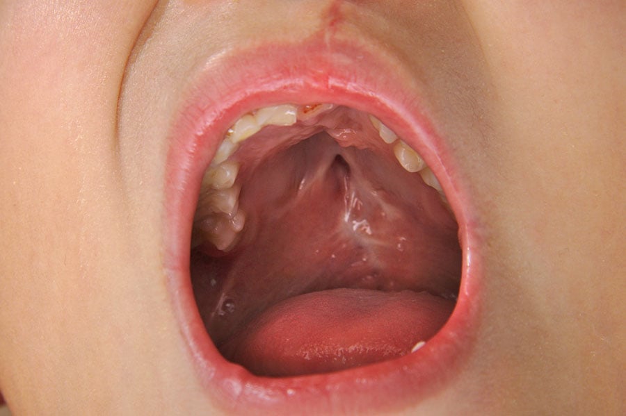 синдром на котешкото око, симптоми