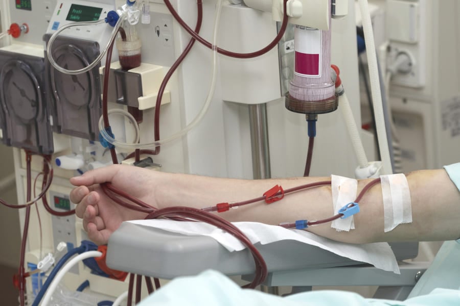 хемодиализа