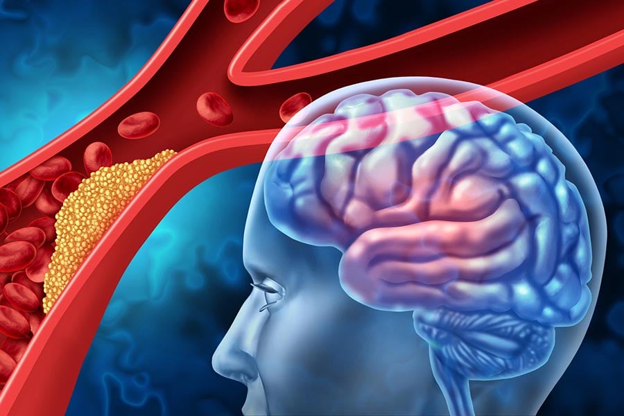 преходна исхемична атака