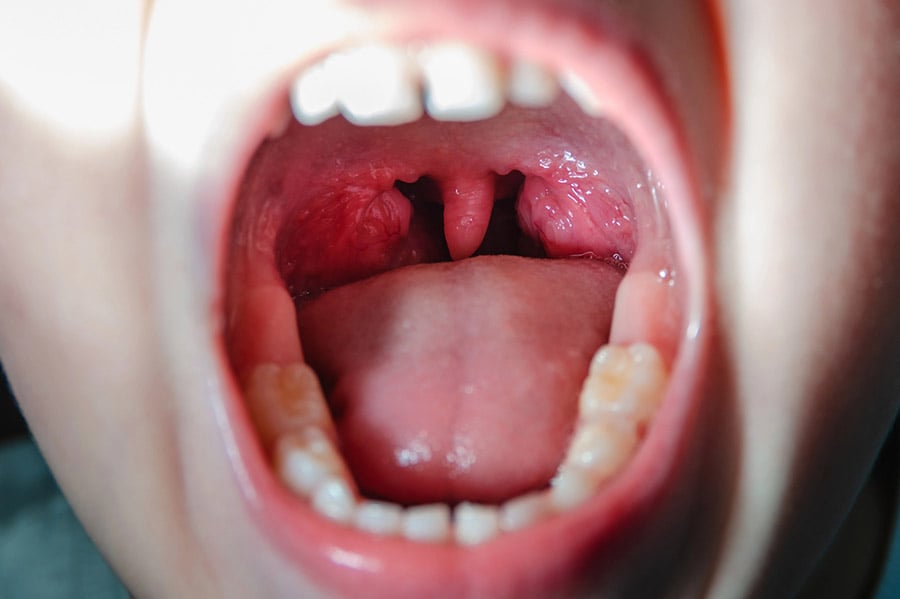 Болести, причинени от Streptococcus pyogenes