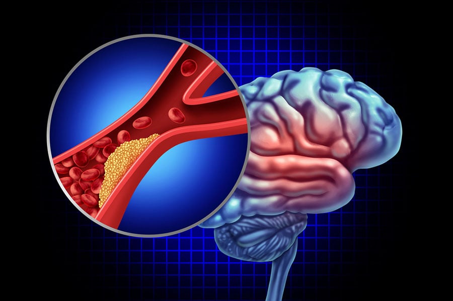 преходна исхемична атака
