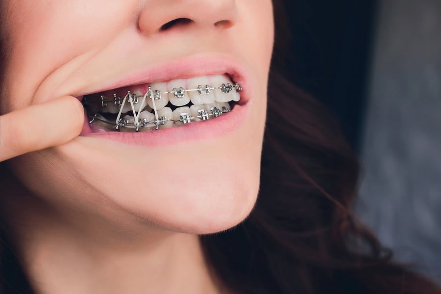 Лечение на дълбока захапка