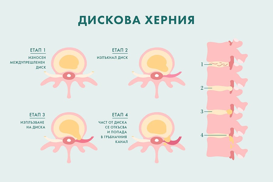 diskova herniya 1
