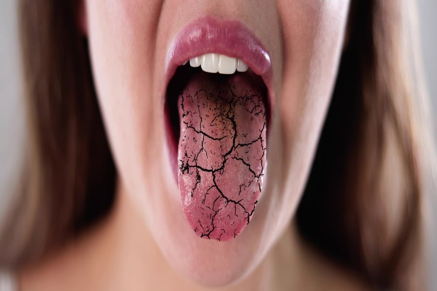 Сухота в устата: Причини и лесни домашни решения 10 Сухота в устата