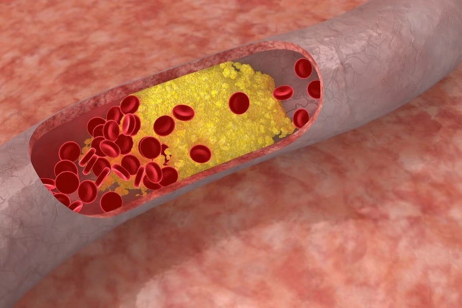 Хранителни добавки за прочистване на кръвоносните съдове 8 Хранителни добавки за прочистване на кръвоносните съдове - запушена артерия
