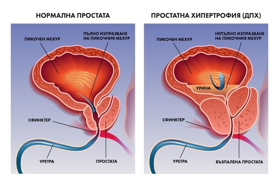 възпаление на простатата