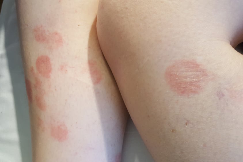 саркоидоза, лезии