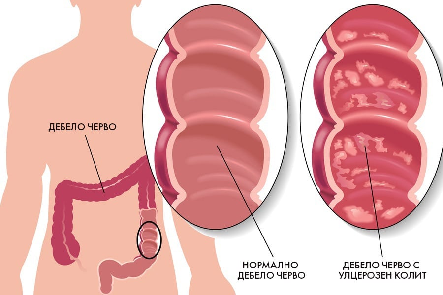 Улцерозен колит