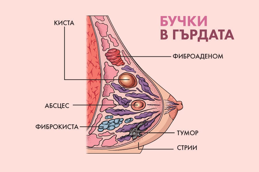 Бучка в гърдата невинаги е повод за тревога 5 бучка в гърдата, видове бучки