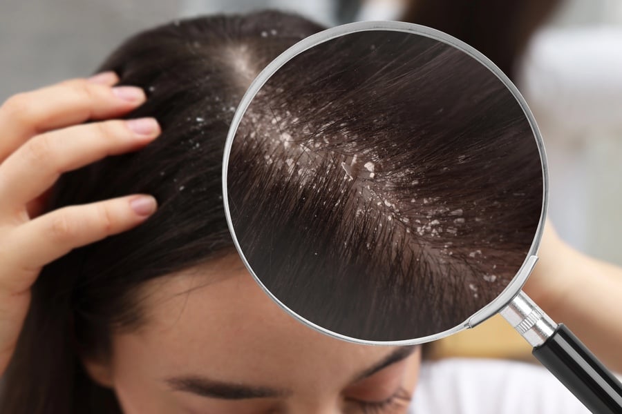 Джинджифил за коса - пърхот