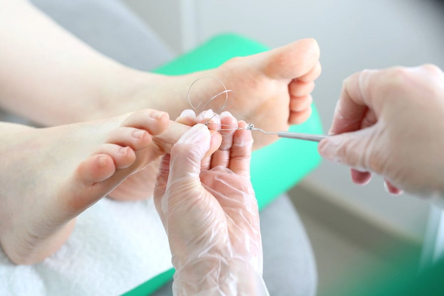 Врастнал нокът - как да избегнем възпаление? 9 Врастнал нокът-операция