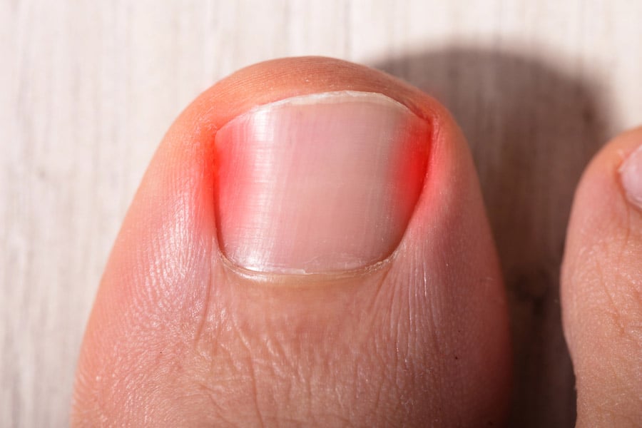 Врастнал нокът - как да избегнем възпаление? 8 Врастнал нокът - симптоми