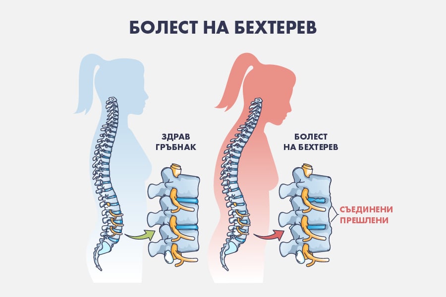 болест на Бехтерев, симптоми
