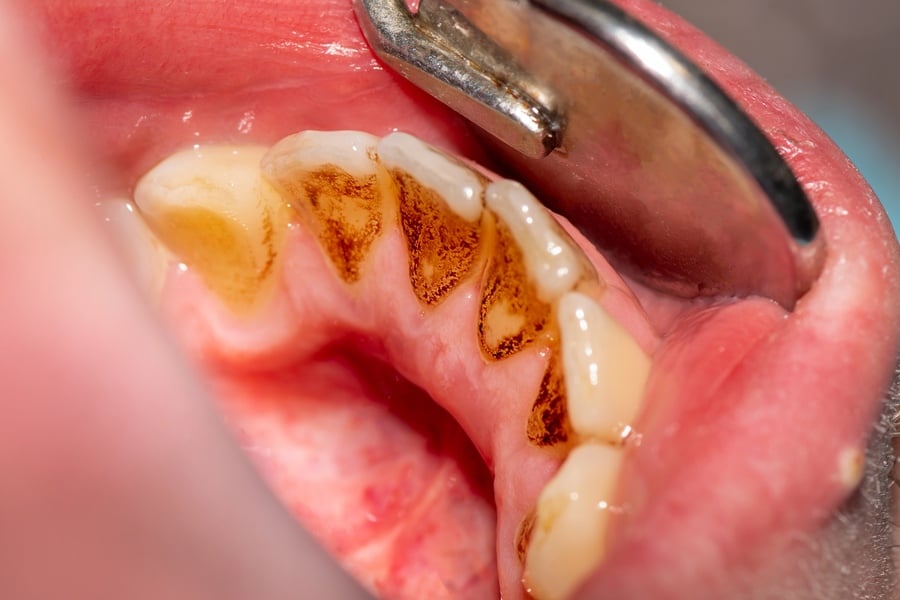 Лоша устна хигиена