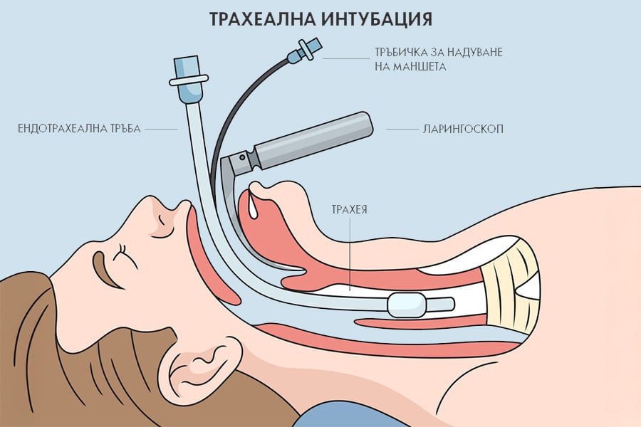 Интубация: какво представлява и кога се прави 5 Видове интубация - трахеална интубация