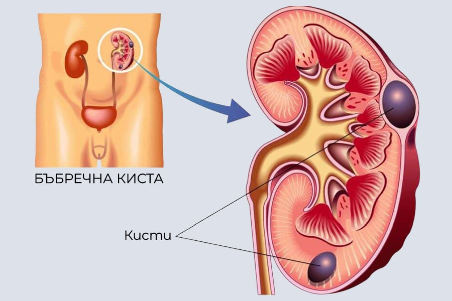 Киста на бъбрека - причини, симптоми и лечение 6 Киста на бъбрека, инфографика.