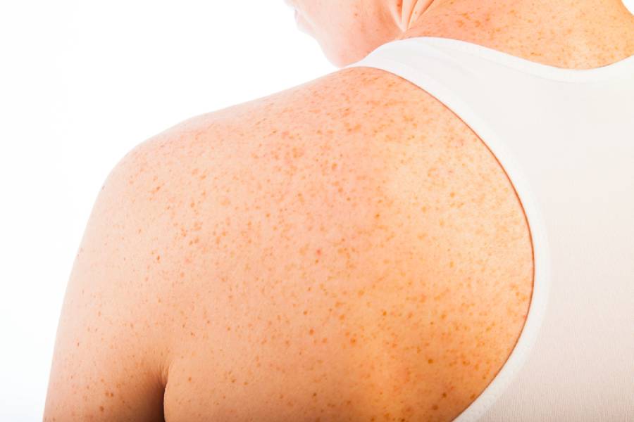 пигментни петна при бременност